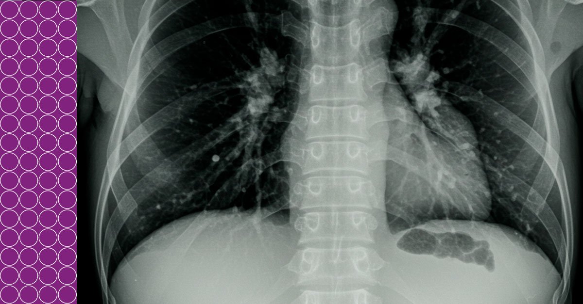 Ensaios de Células T para o Diagnóstico de Tuberculose latente