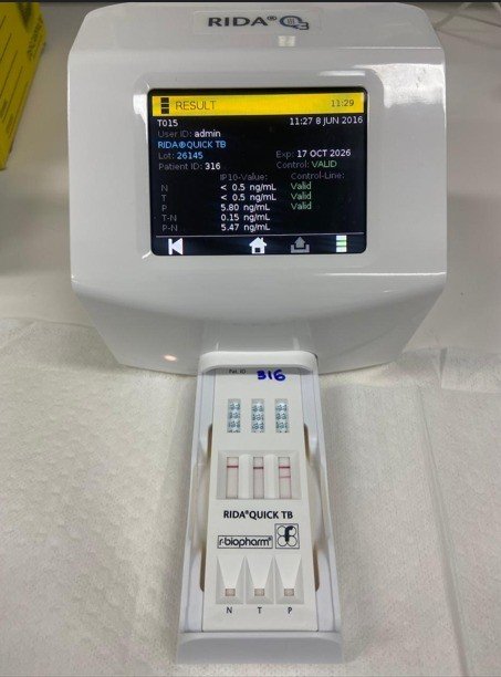 Diagnóstico rápido e políticas públicas no combate a tuberculose