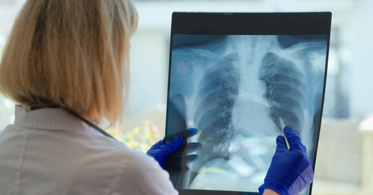 IP-10 no Diagnóstico da Tuberculose Latente - evidência clínica